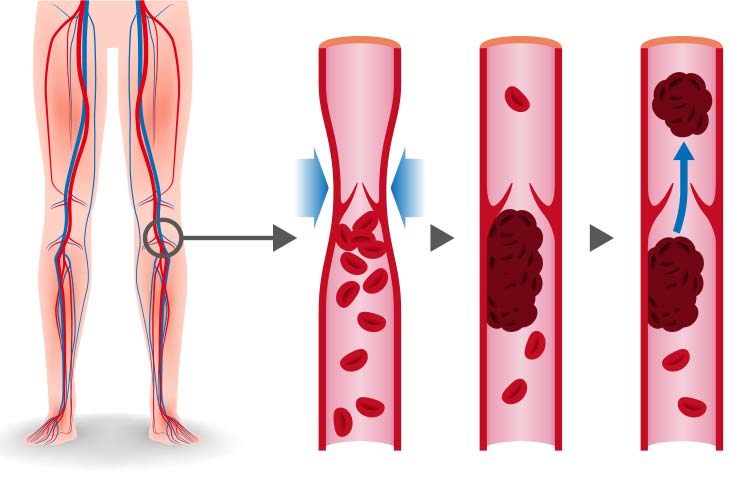 硬膜静脈洞血栓症の原因は何ですか?